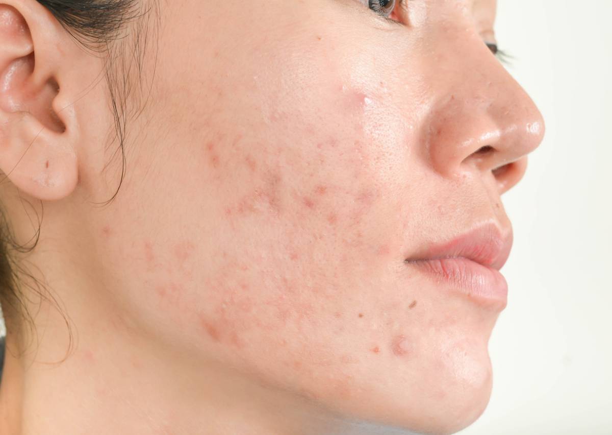 Featured image for Why Do Acne Scars Develop