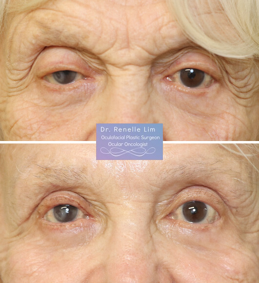 Pt is s/p trichophytic brow lift, upper eyelid blepharoplasty and ptosis surgery. Only 1.5 weeks post op - she is looking and feeling great! She is 83 years old! Age at nothing but a number :)