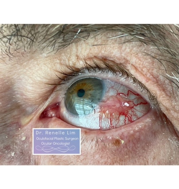 Eyelid Conjunctival Tumors