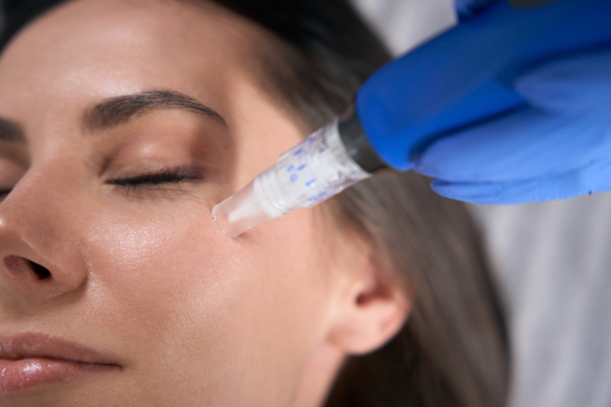 Featured image for How Does Microneedling Work?