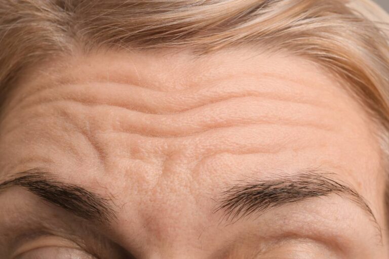 Female forehead with wrinkles.