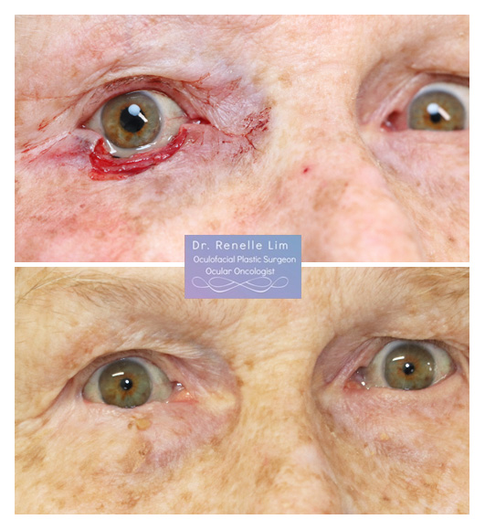 6 months post mohs and reconstruction for a right lower eyelid BCC