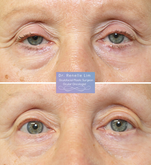 This patient has ptosis repair 6 days ago! No sutures were used