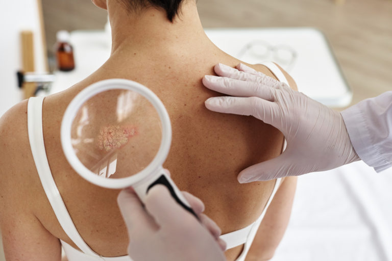 The image shows a close up of doctor holding magnifying glass while examining back of female patient with rash spots in dermatology clinic as a way to introduce the most common dermatological conditions.