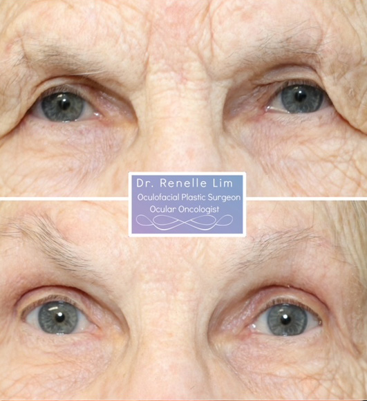 Patient in her 80’s underwent bilateral upper eyelid blepharoplasty and brow lift.