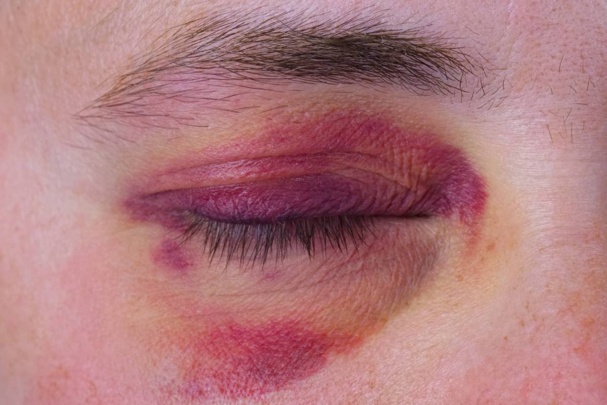 Featured image for What Should You Do If You Suffer Orbital Trauma?